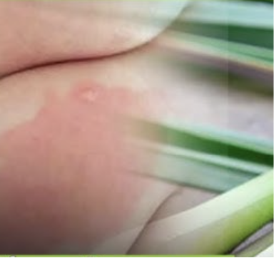 Thực hư những mẹo trị chàm bớt trên thị trường