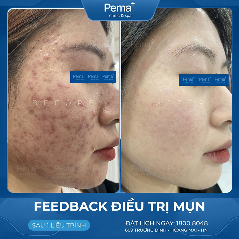 Kết quả điều trị