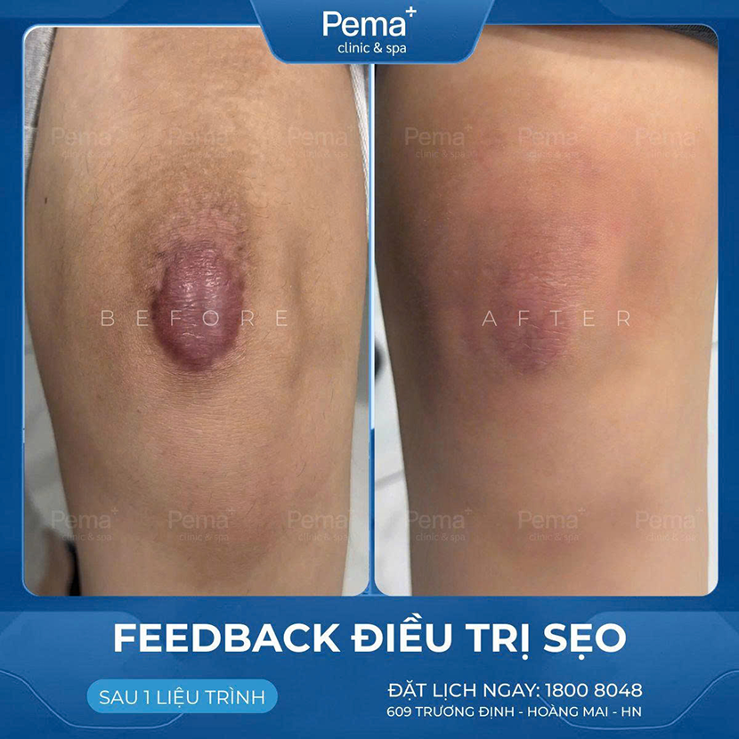 Kết quả điều trị