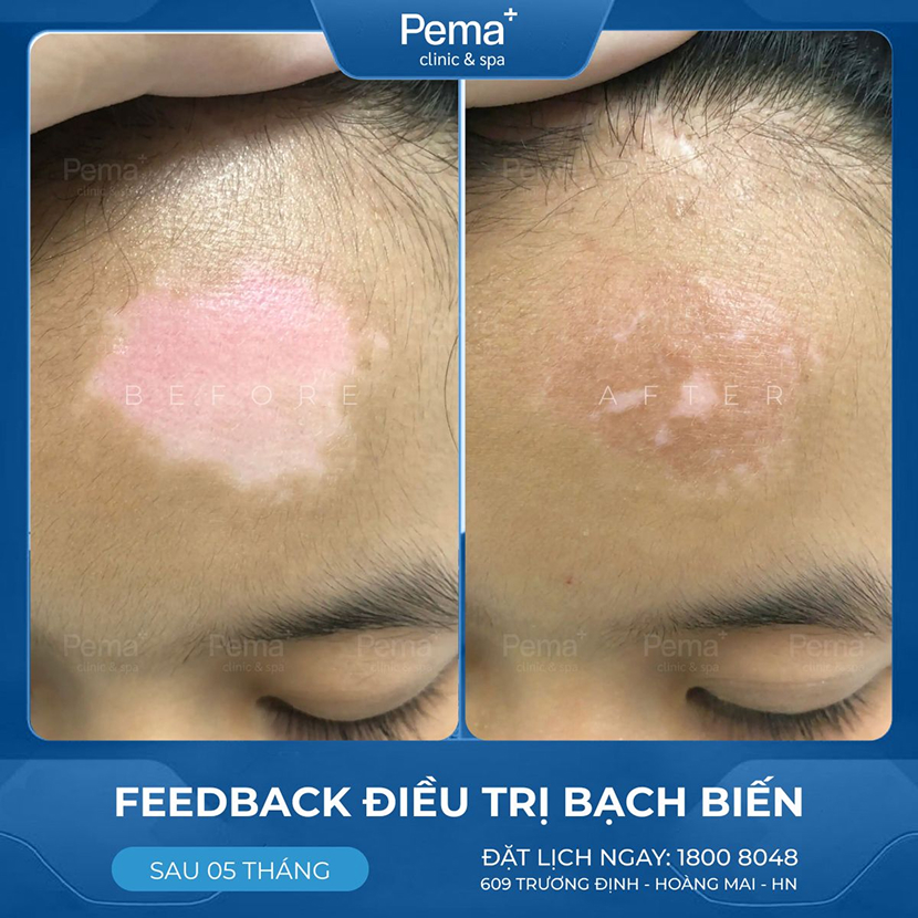 Kết quả điều trị