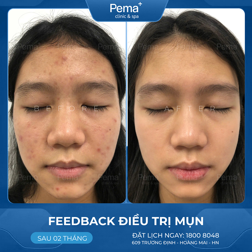 Kết quả điều trị