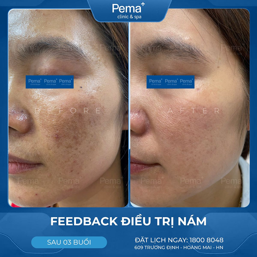 Kết quả điều trị