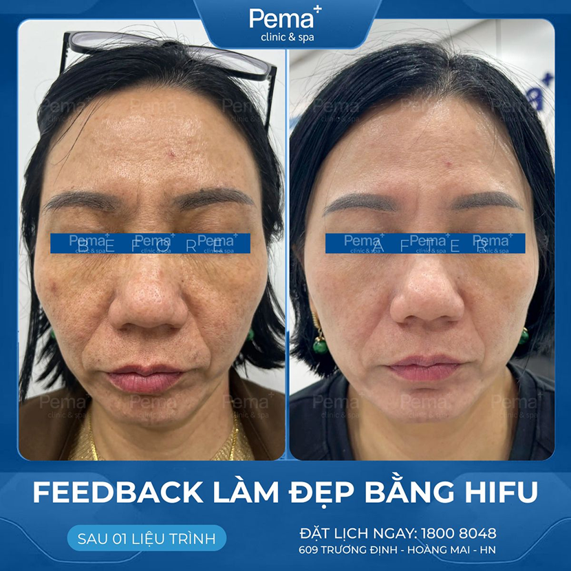 Kết quả điều trị