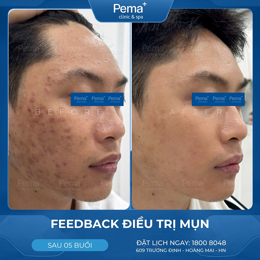 Kết quả điều trị