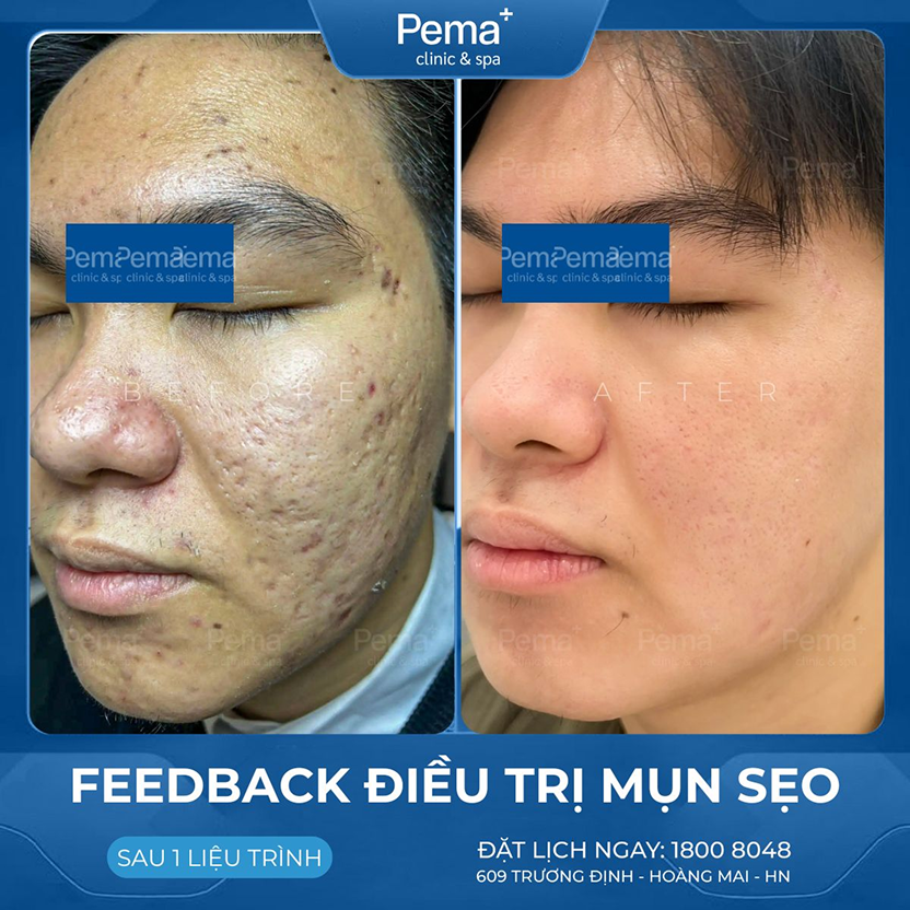 Kết quả điều trị