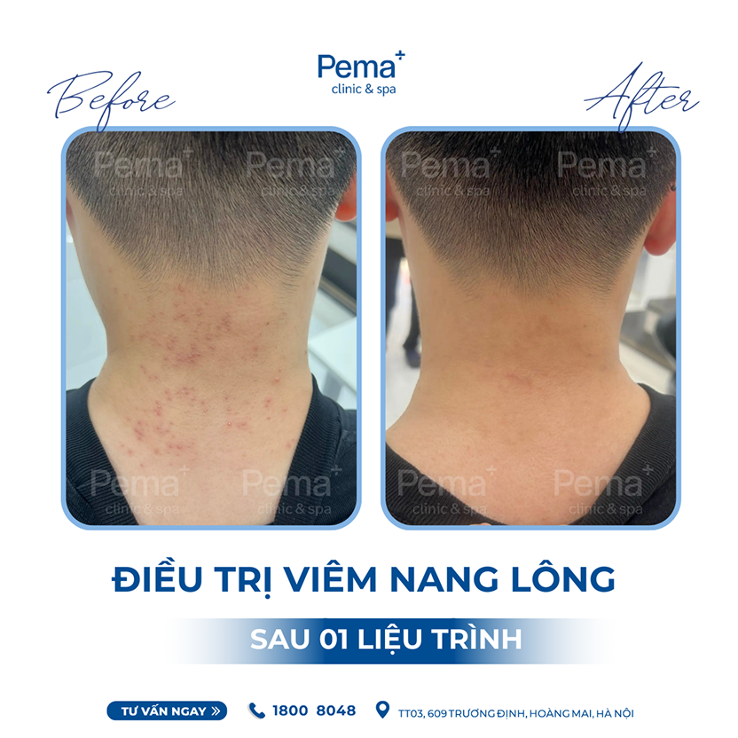 Kết quả điều trị