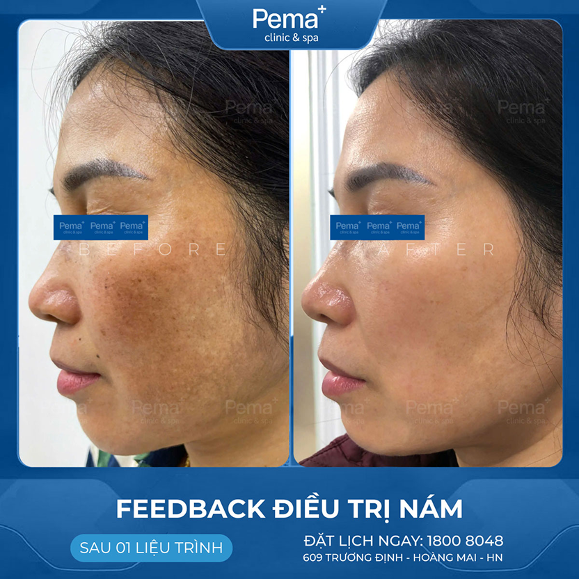 Kết quả điều trị