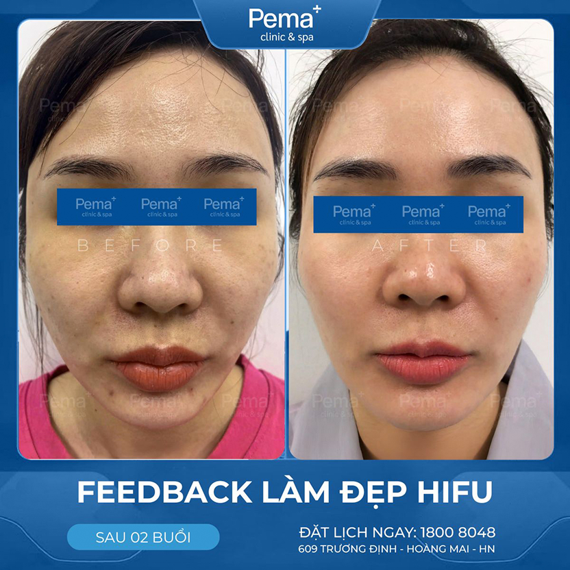 Kết quả điều trị