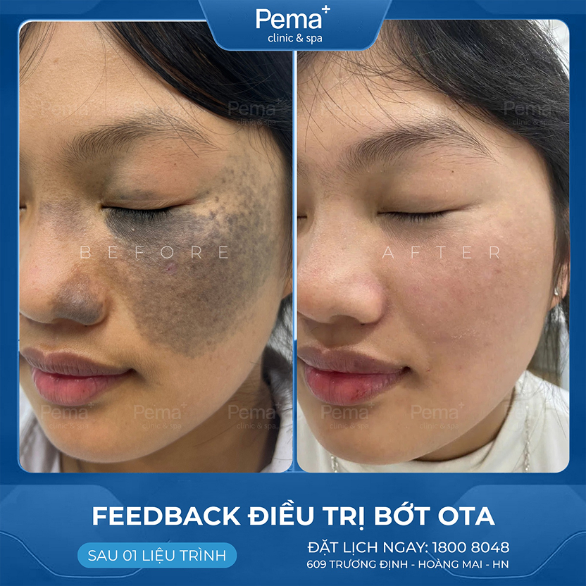 Kết quả điều trị